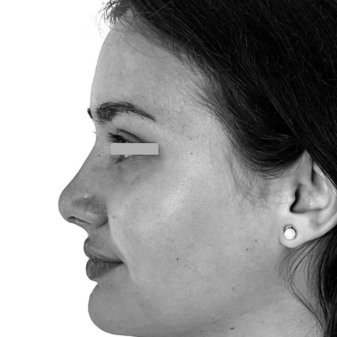Après — patient 1 du Dr Chacra, de profil
