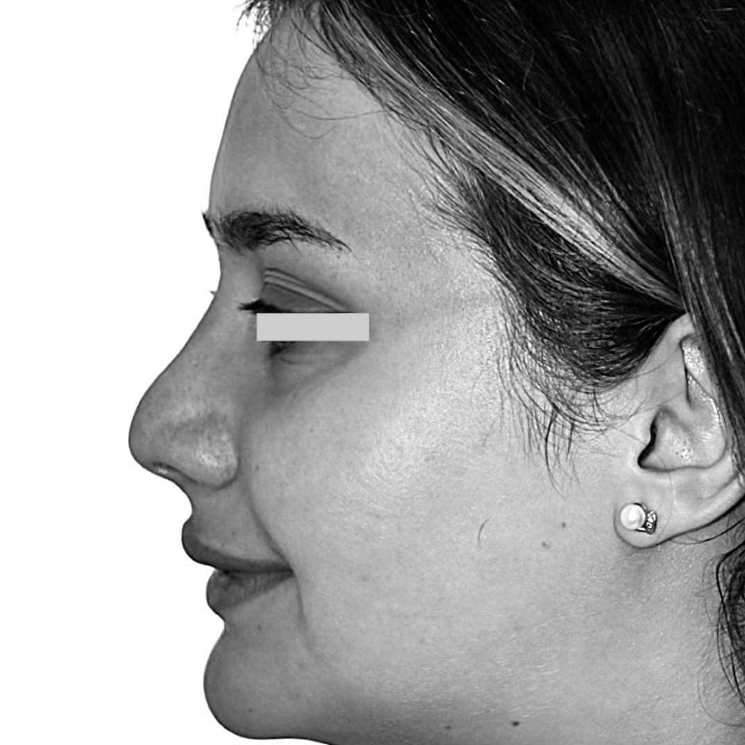 Avant — patient 1 du Dr Chacra, de profil