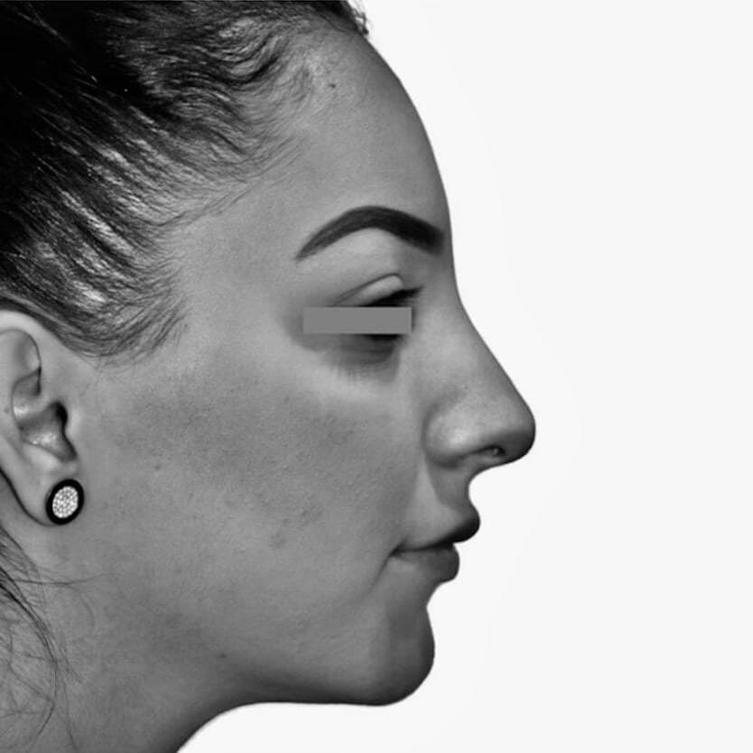 Avant — patient 2 du Dr Chacra, de profil