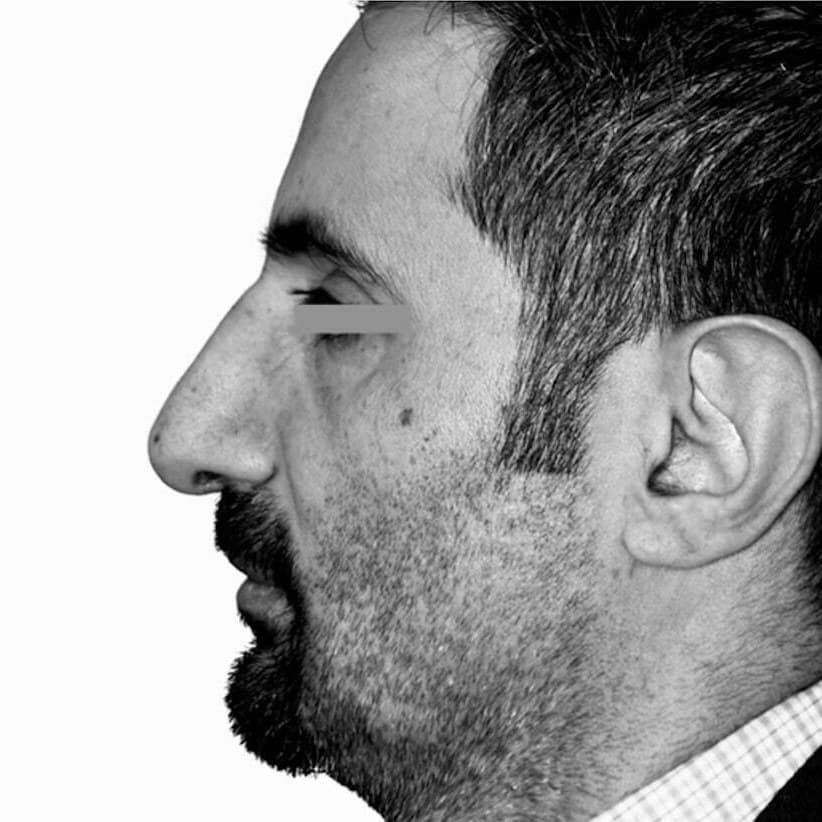 Après — patient 3 du Dr Chacra, de profil