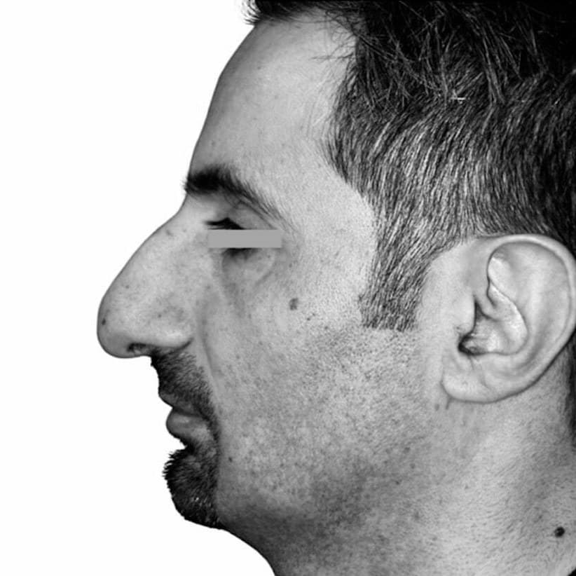 Avant — patient 3 du Dr Chacra, de profil